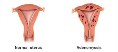 adenomyosis treatment natural