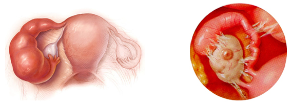 how to cure Hydrosalpinx
