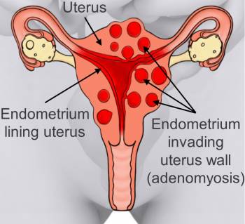 adenomyosis treatment