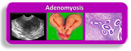 Adenomyosis