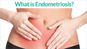 endometriosis treatment