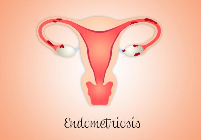 endometriosis treatment