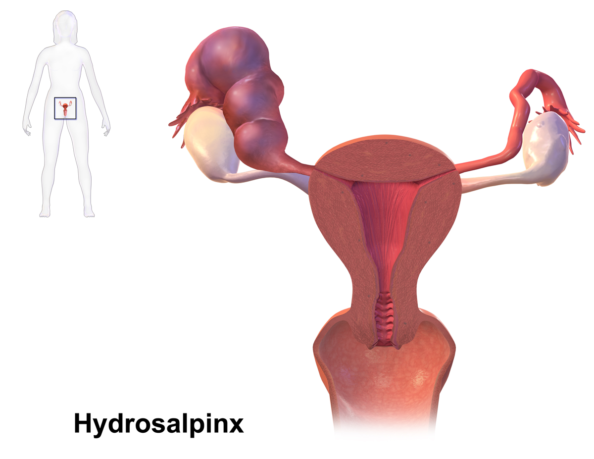 Hydrosalpinx treatment