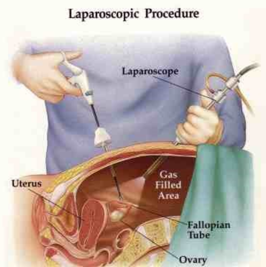 Tubal Blockage Surgical Treatment