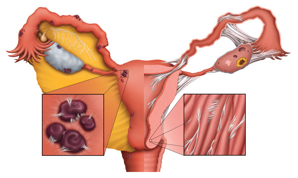IVF For Blocked Fallopian Tubes