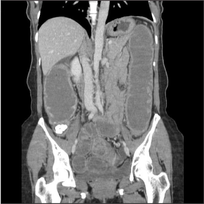 Thoracic endometriosis