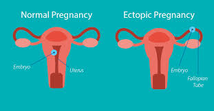 ectopic pregnancy