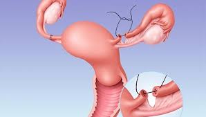 tubal anastomosis