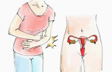 irregular menstruation
