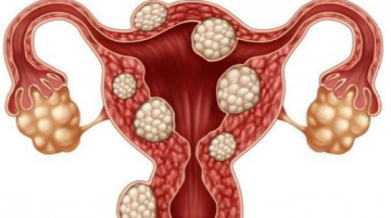 endometriosis