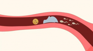 blocked fallopian tube