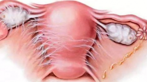pelvic effusion