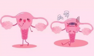 endometriosis