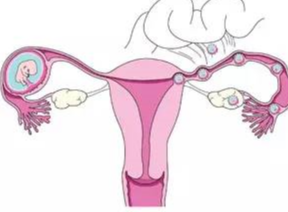 Endometriosis